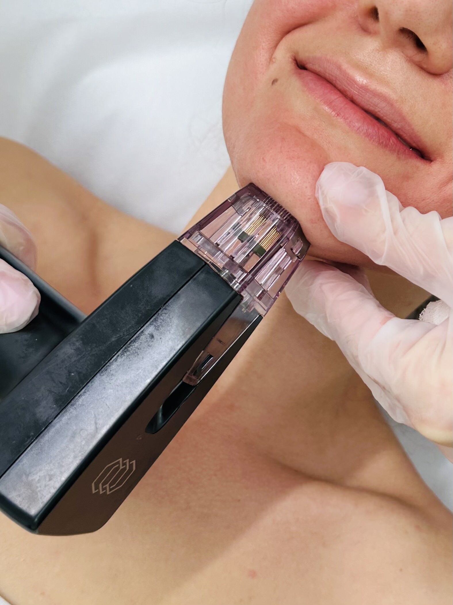 IMG_2157 Morpheus8 за естетсвено подмладяване без хирургия, стягане на кожа, премахване на бръчки, премахване на стрии и целулит